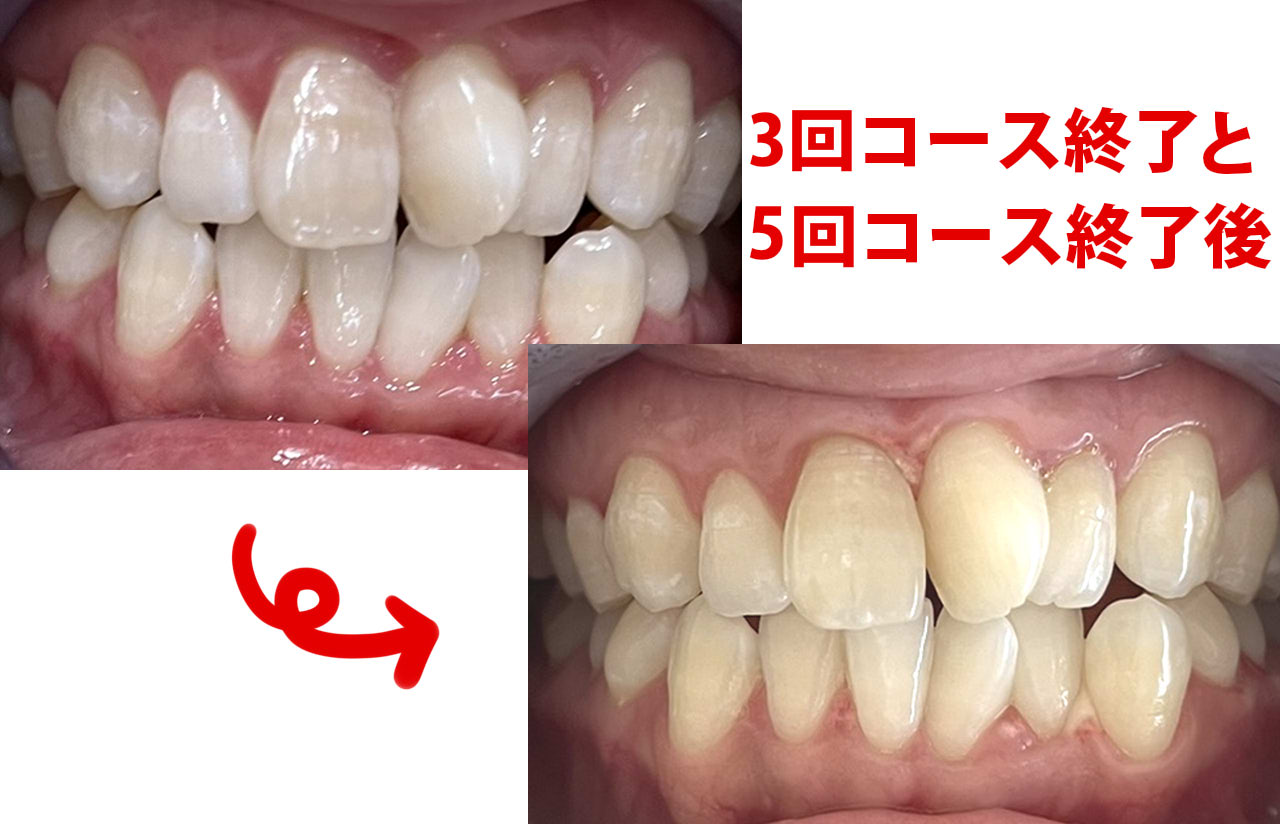 ホワイトニングショップ鳳　5回コース