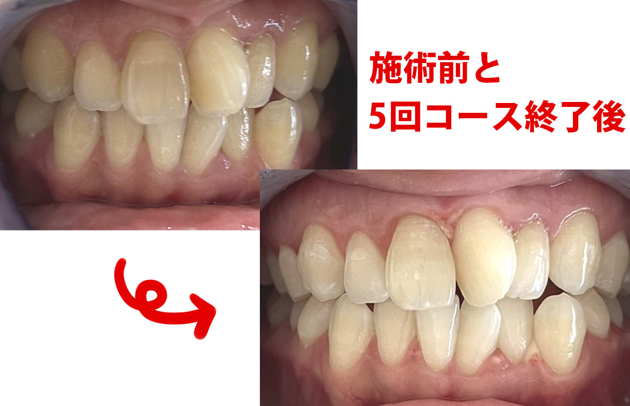 ホワイトニングショップ鳳　5回コース